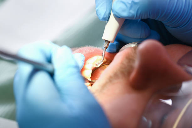 Best Emergency Tooth Extraction in Dover, NH